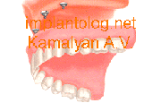 Имплантация зубов и фиксация на шаровидных аббатментах